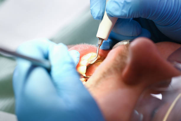 Teeth Whitening in OH