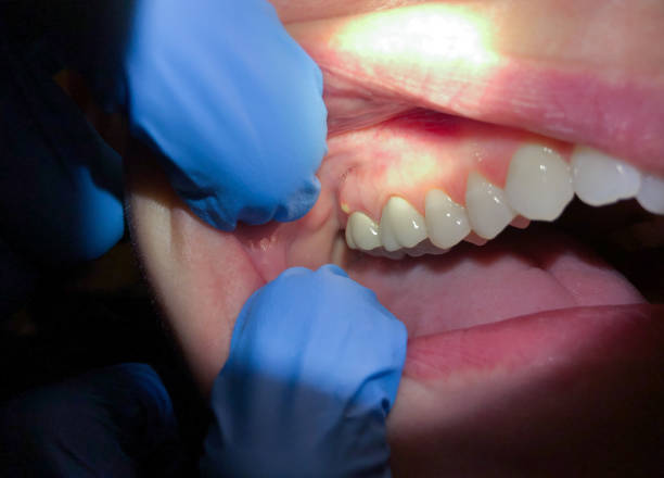 Best Broken Tooth Emergency  in Buckeye Lake, OH
